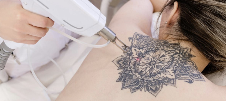タトゥーを消す際に用いられる手術の種類