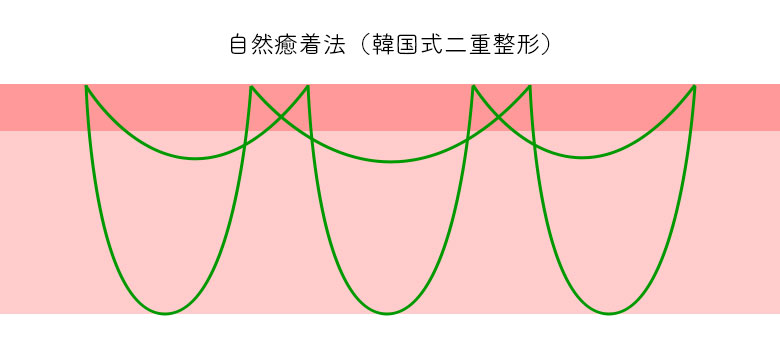 自然癒着法