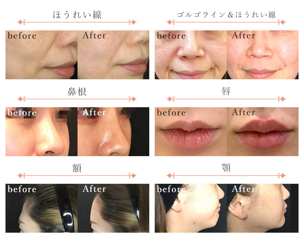 症例写真：ほうれい線、ゴルゴライン＆ほうれい線、鼻根、唇、額、アゴ
