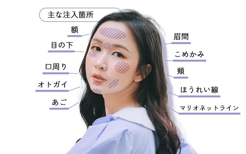 ヒアルロン酸注入箇所：額、目の下、口周り、オトガイ、あご、眉間、こめかみ、頬、ほうれい線、マリオネットライン