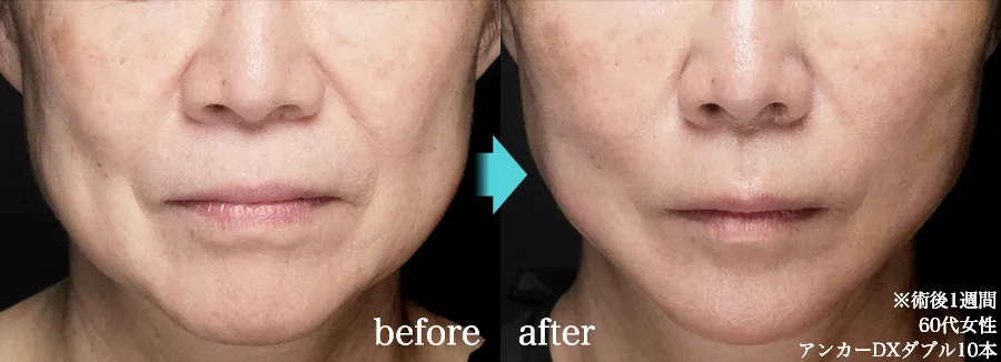 糸リフト 症例写真 Before After 1