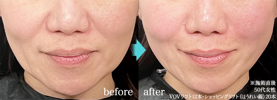 糸リフト 症例写真 Before After 2