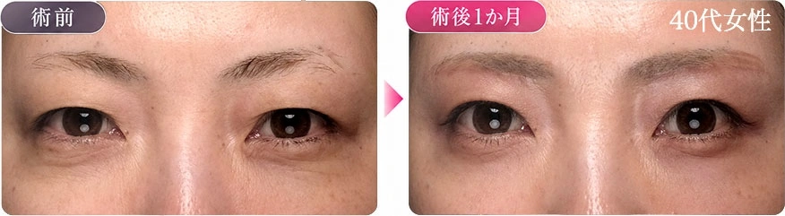 眉下切開 症例写真 術前 術後1か月