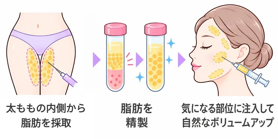 脂肪注入（入れ放題）の施術のしくみ