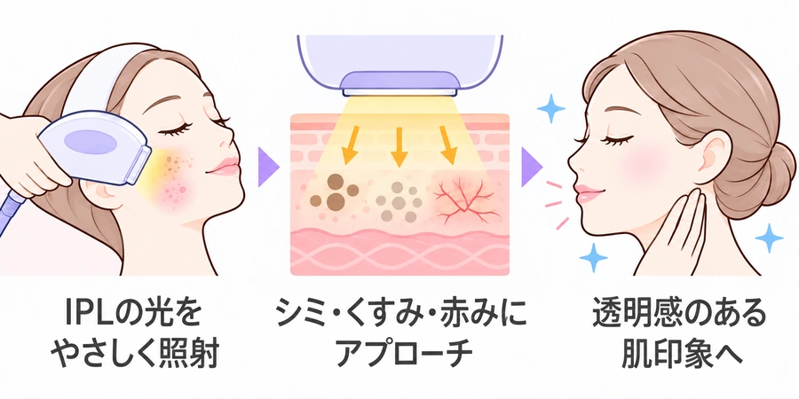 フォトフェイシャルM22の施術のしくみ