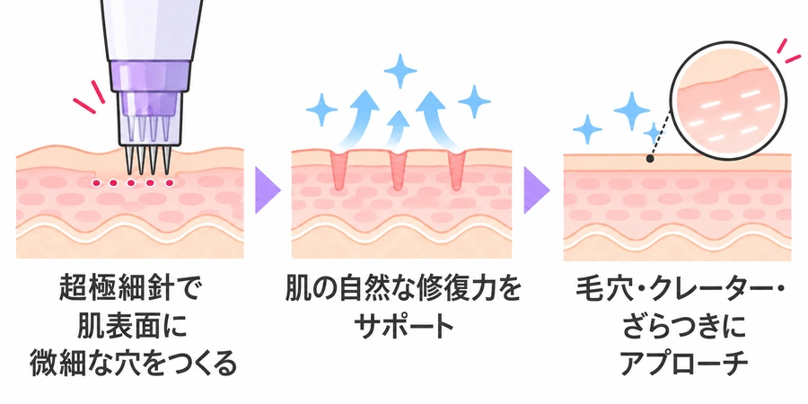 ダーマペン4の施術のしくみ