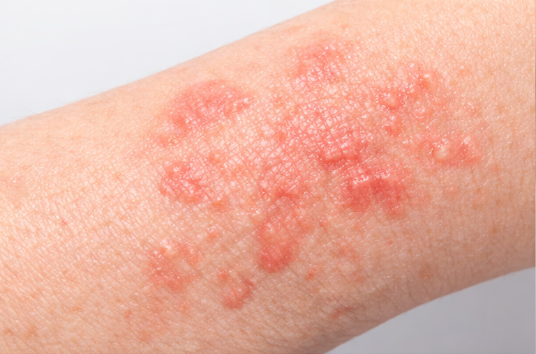 湿疹・かぶれの症例イメージ