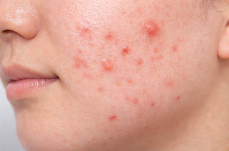 ニキビの症例イメージ