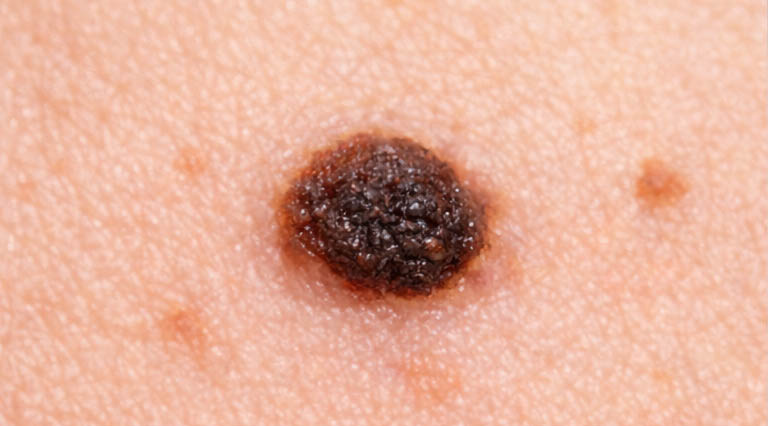 ほくろの症例イメージ