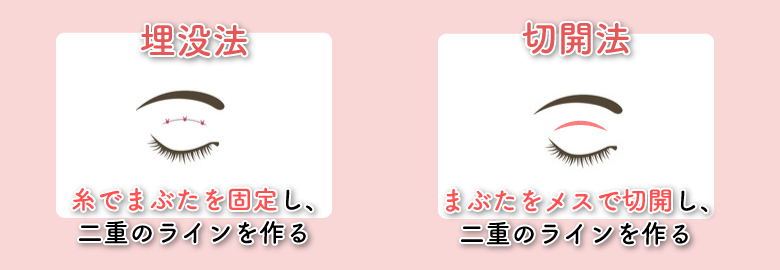 埋没法と切開法の違い