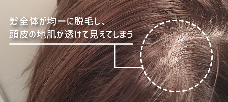 びまん性脱毛症