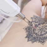 タトゥーを消したい人必見!除去する方法・費用・期間を徹底解説!