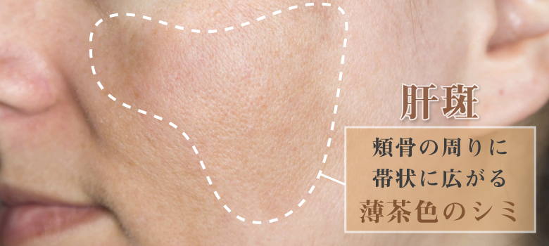 肝斑とは？シミとは違う？