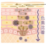 ニキビ跡の色素沈着を消したい!色素沈着の原因と治療方法を紹介