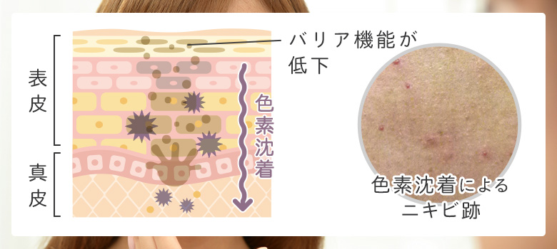 ニキビ跡が色素沈着を起こす原因
