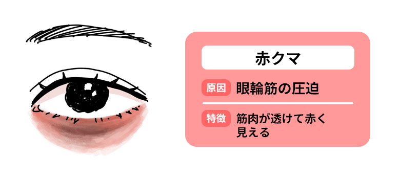 赤クマの特徴と原因b