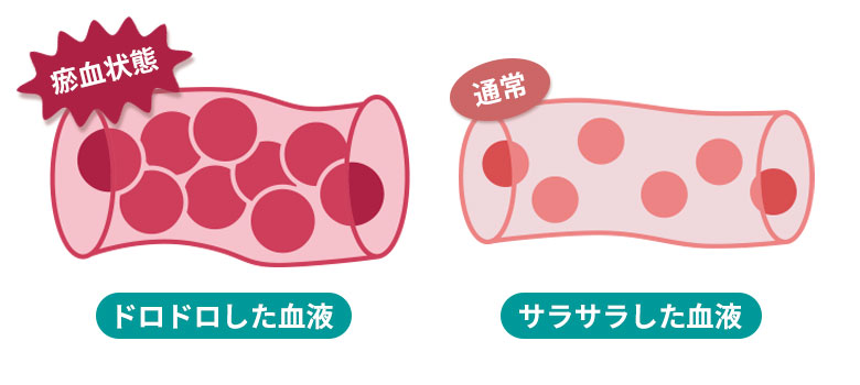 血の巡りが悪い瘀血体質