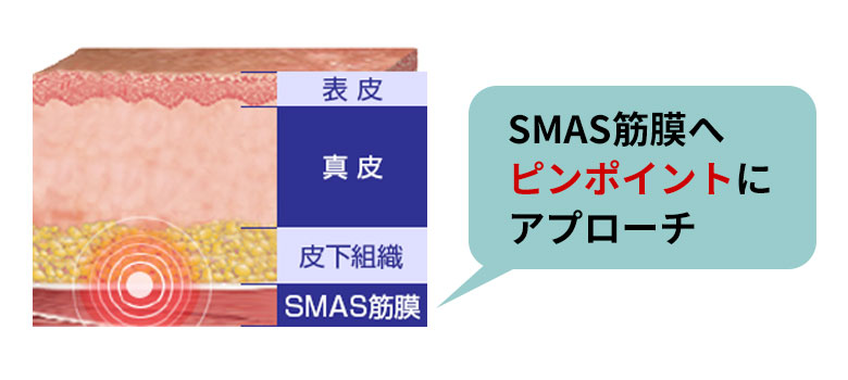 SMAS筋膜