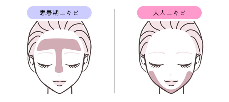 思春期ニキビと大人ニキビ