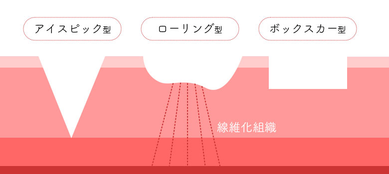 ニキビ跡の種類