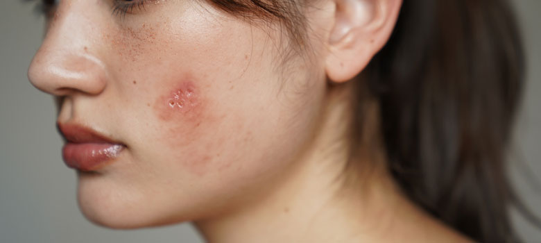 大人ニキビ
