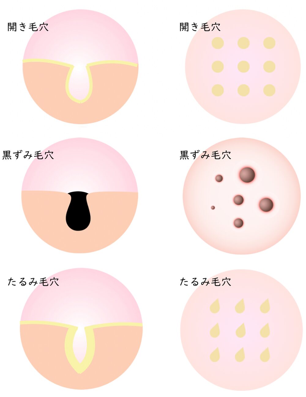 毛穴の種類と原因|パターン