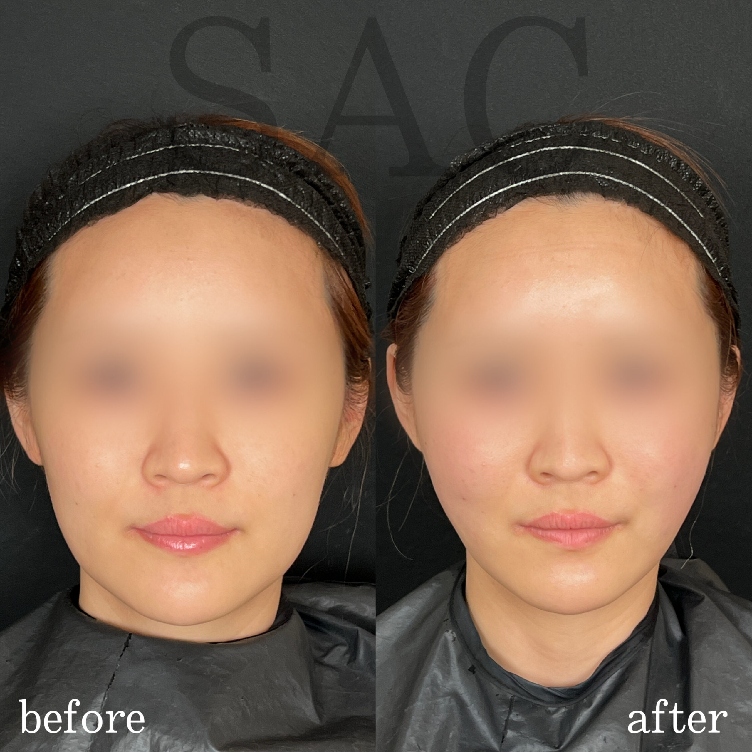 オーダーメイド糸リフト