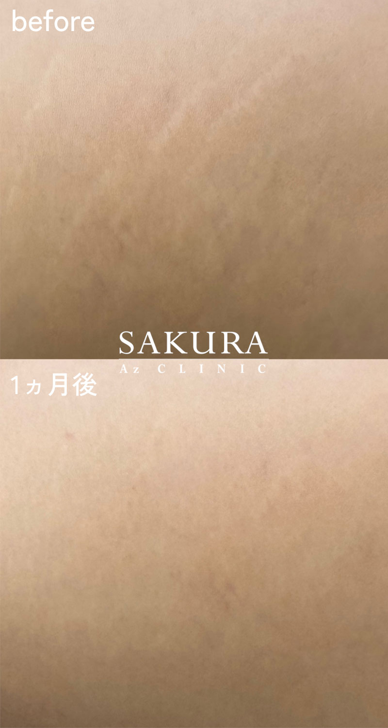ストレッチマーク《妊娠線、肉割れ線》(カモフラージュ)モニター