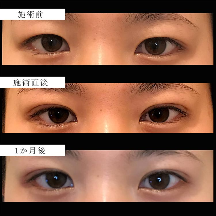 切らない二重術