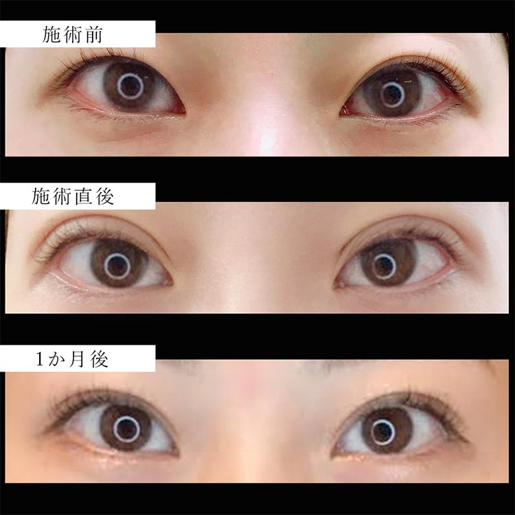 切らない二重術