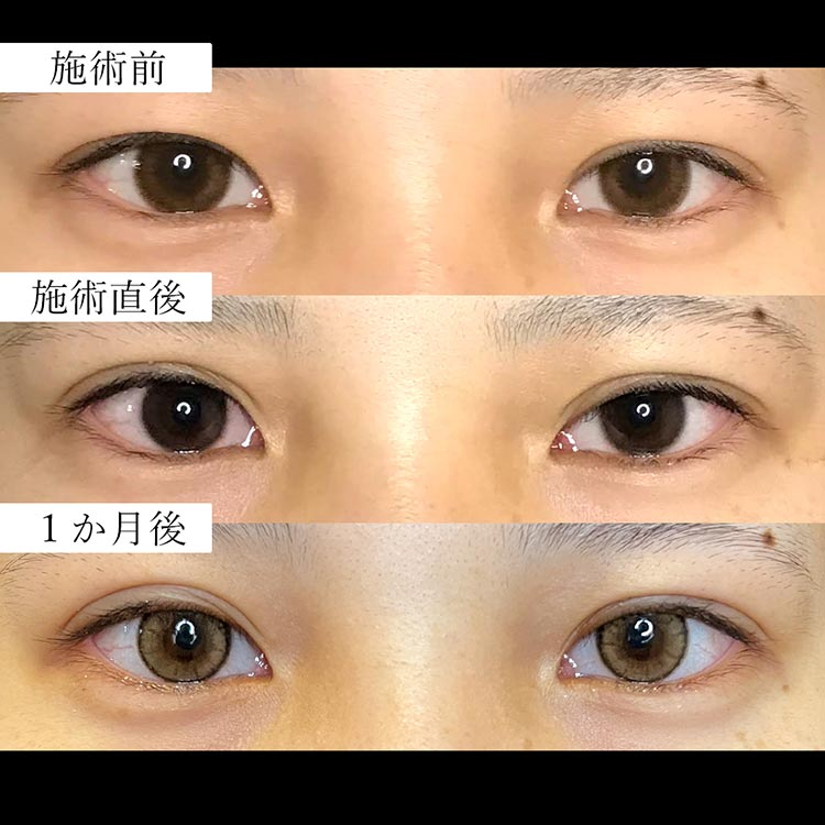 切らない二重術