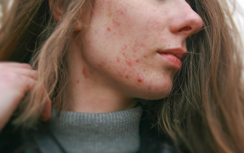 ピコフラクショナルのイメージ