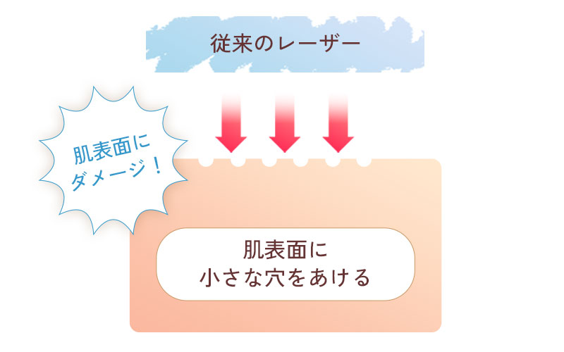 従来のフラクショナルレーザー