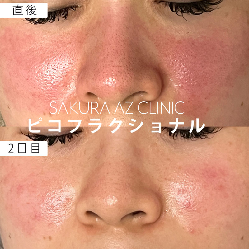 ピコフラクショナル