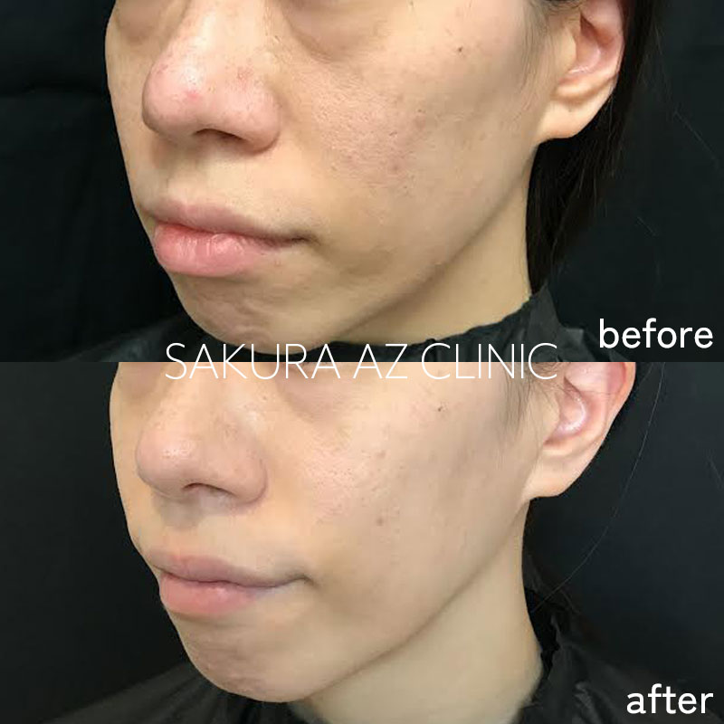 ピコフラクショナル