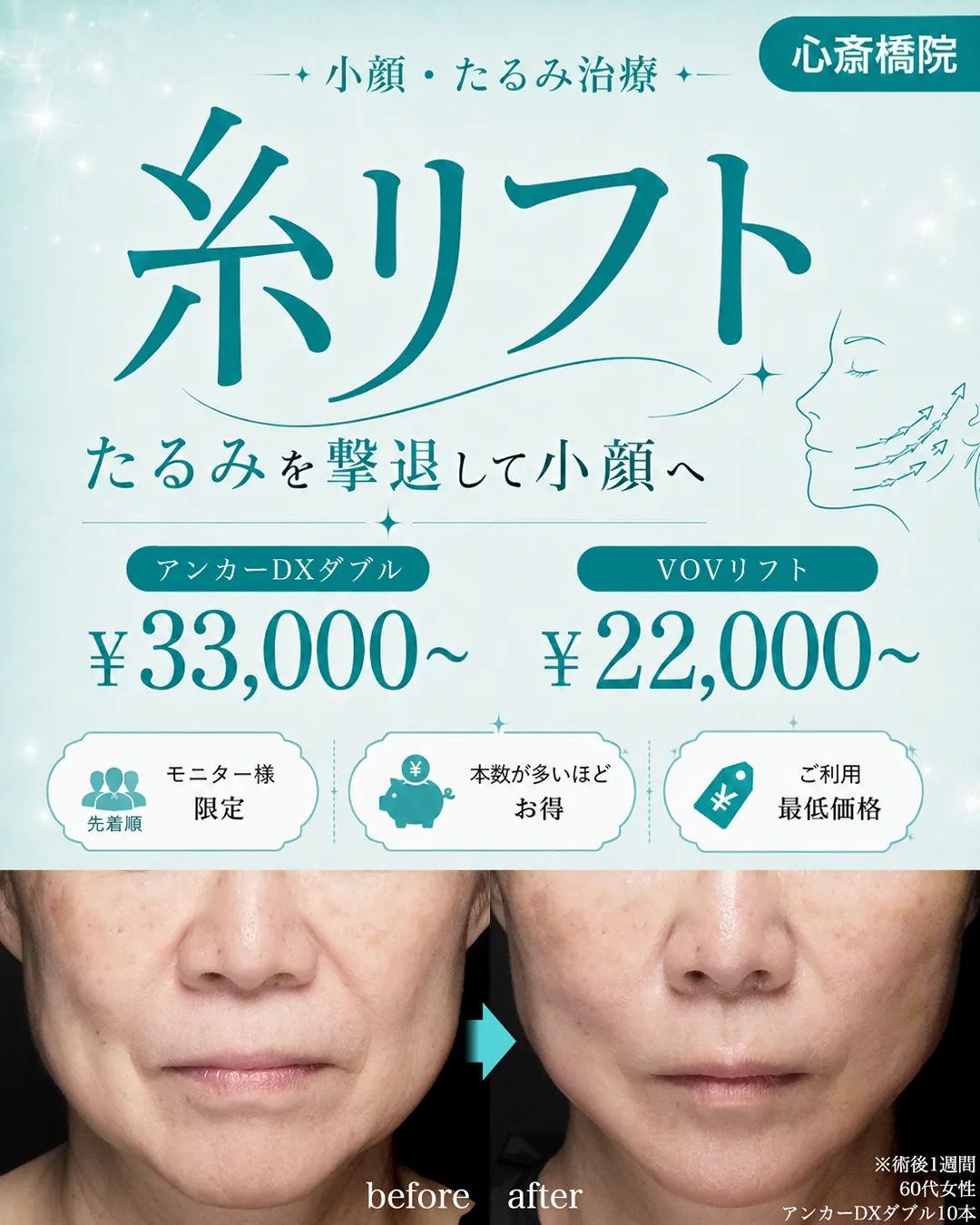 [9月]たるみを引き上げ小顔へ