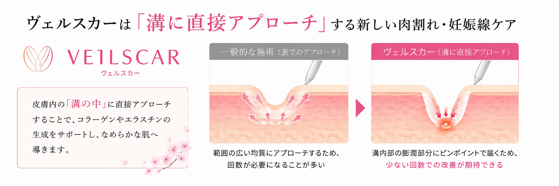 ヴェルスカー メソッド